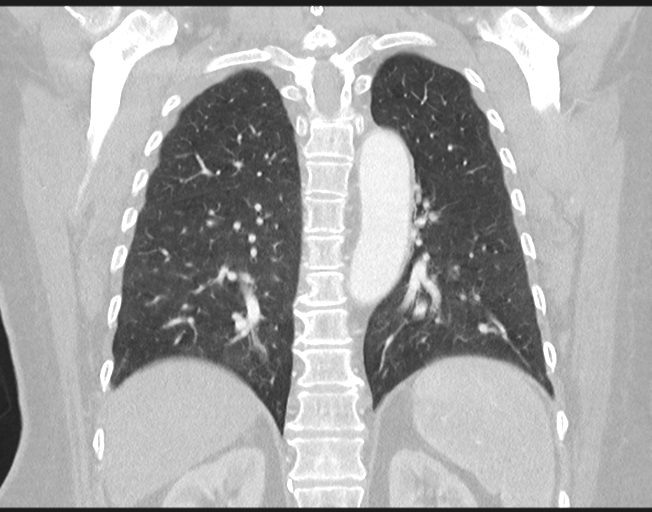 Cerebral metastasis to basal ganglia (Radiopaedia 81568-95414 Coronal lung window 60).png