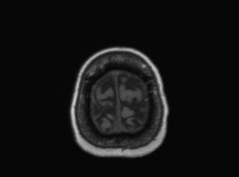 Cerebral ring enhancing lesions - cerebral metastases (Radiopaedia 44922-48817 Axial T1 112).jpg