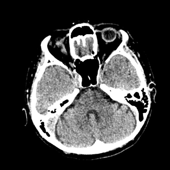 Cerebral ring enhancing lesions - cerebral metastases (Radiopaedia 44922-48818 Axial non-contrast 32).jpg