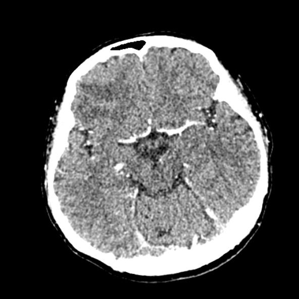 Cerebral ring enhancing lesions - cerebral metastases (Radiopaedia 44922-48818 B 115).jpg