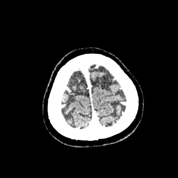 Cerebral ring enhancing lesions - cerebral metastases (Radiopaedia 44922-48818 B 263).jpg