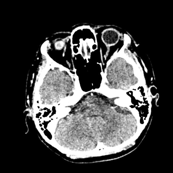 Cerebral ring enhancing lesions - cerebral metastases (Radiopaedia 44922-48818 B 78).jpg