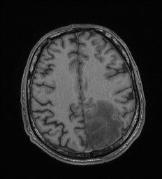Cerebral toxoplasmosis (Radiopaedia 43956-47461 Axial T1 56).jpg