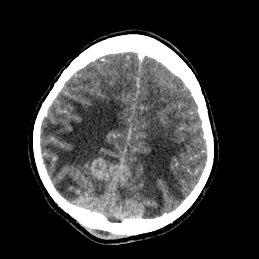 File:Cerebral tuberculosis with dural sinus invasion (Radiopaedia 60353-68019 Axial C+ delayed 50).jpg
