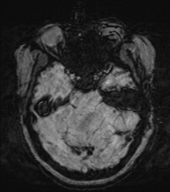 Cerebral venous infarct (Radiopaedia 53627-59685 Axial SWI 15).jpg
