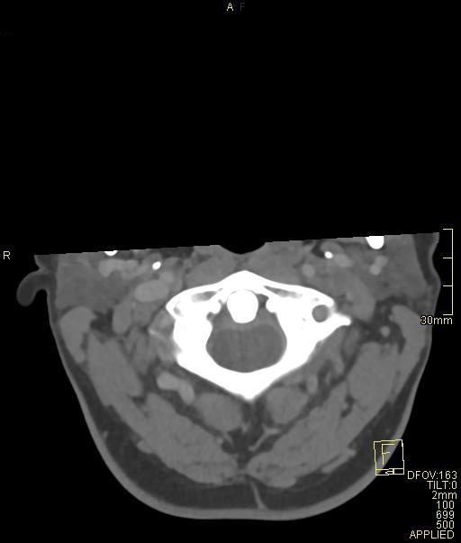 Cerebral venous sinus thrombosis (Radiopaedia 91329-108965 Axial venogram 4).jpg