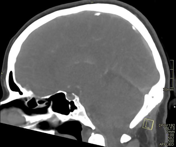 Cerebral venous sinus thrombosis (Radiopaedia 91329-108965 Sagittal venogram 40).jpg