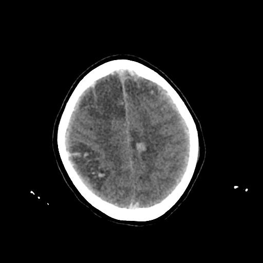 Cerebral venous throbmosis - hemorrhagic venous infarction (Radiopaedia 87318-103613 Axial non-contrast 131).jpg