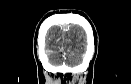 File:Cerebral venous thrombosis (CVT) (Radiopaedia 77524-89685 C 60).jpg