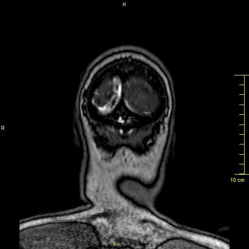 Cerebral venous thrombosis (Radiopaedia 23288-23351 MRV 173).JPG