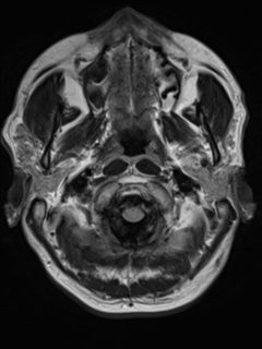 File:Cerebral venous thrombosis (Radiopaedia 38392-40469 Axial FLAIR 2).png
