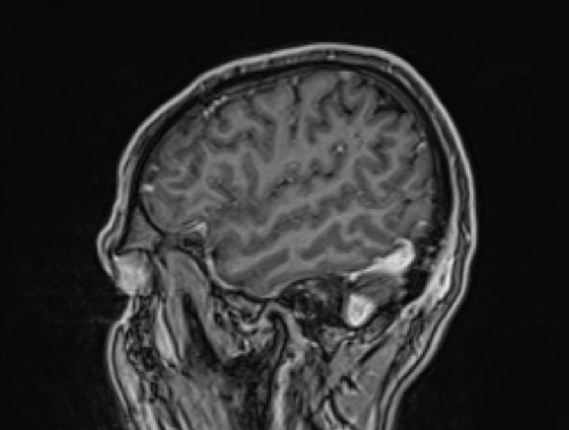 Cerebral venous thrombosis (Radiopaedia 71207-81504 Sagittal T1 C+ 53).jpg