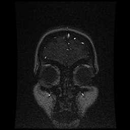 Cerebral venous thrombosis - ulcerative colitis (Radiopaedia 66049-75219 Coronal MRV 104).jpg