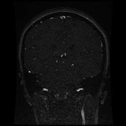 Cerebral venous thrombosis - ulcerative colitis (Radiopaedia 66049-75219 Coronal MRV 49).jpg