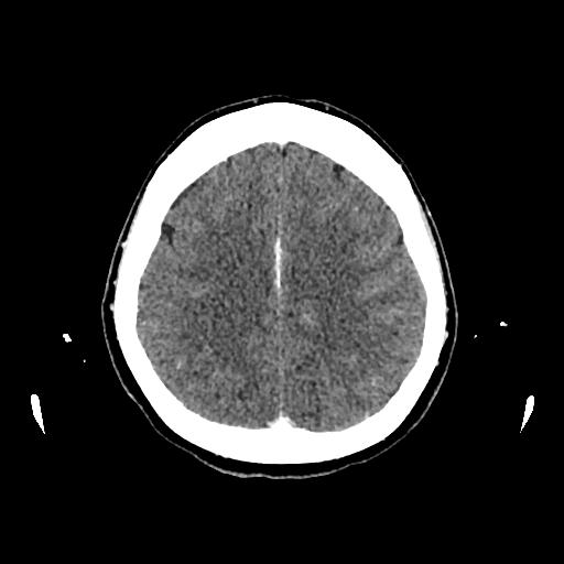 File:Cerebral venous thrombosis with venous hemorrhagic infarct (Radiopaedia 90354-107660 Axial with contrast 120).jpg