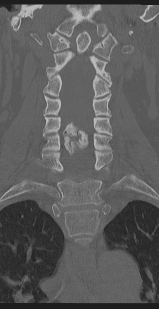 Cervical canal stenosis due to ossification of the posterior longitudinal ligament (Radiopaedia 47260-51823 Coronal bone window 26).png