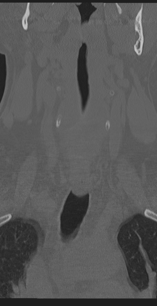 Cervical canal stenosis due to ossification of the posterior longitudinal ligament (Radiopaedia 47260-51823 Coronal bone window 8).png