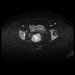 Cervical carcinoma (Radiopaedia 88010-104555 Axial DWI 70).jpg