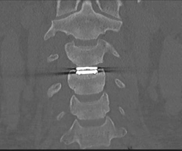 File:Cervical disc replacement (Radiopaedia 44025-47541 Coronal bone window 17).png