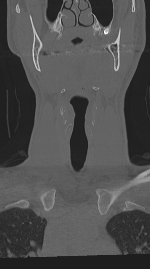 Cervical intercalary bone (Radiopaedia 35211-36748 Coronal bone window 10).png