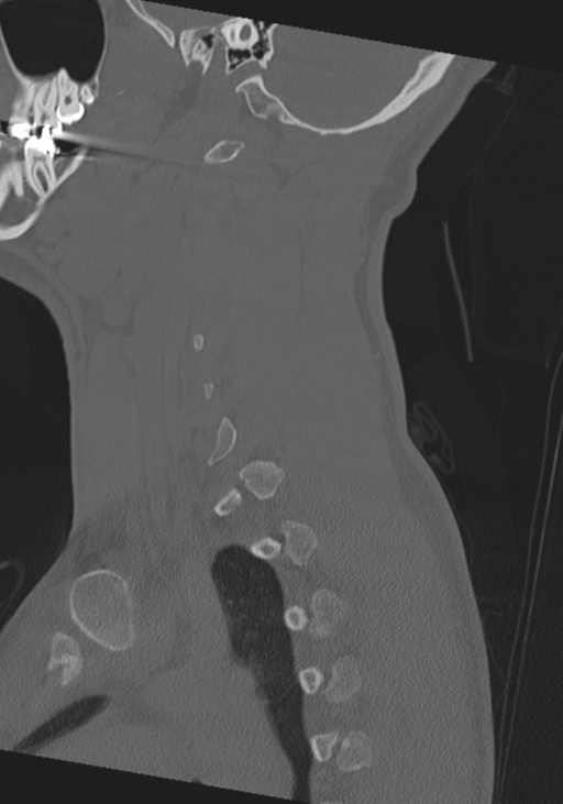 Cervical intercalary bone (Radiopaedia 35211-36748 Sagittal bone window 20).png