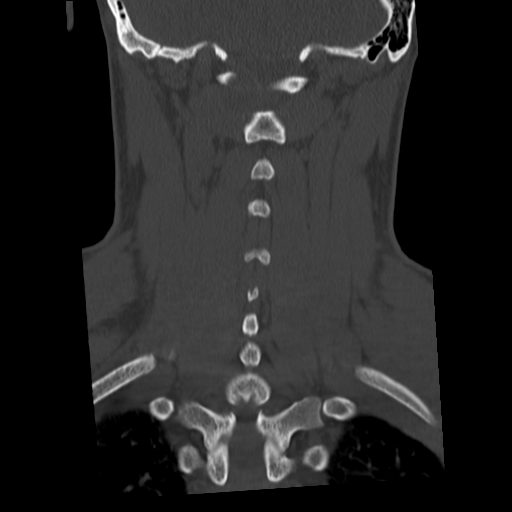 Cervical schwannoma (Radiopaedia 57979-64974 Coronal bone window 41).png
