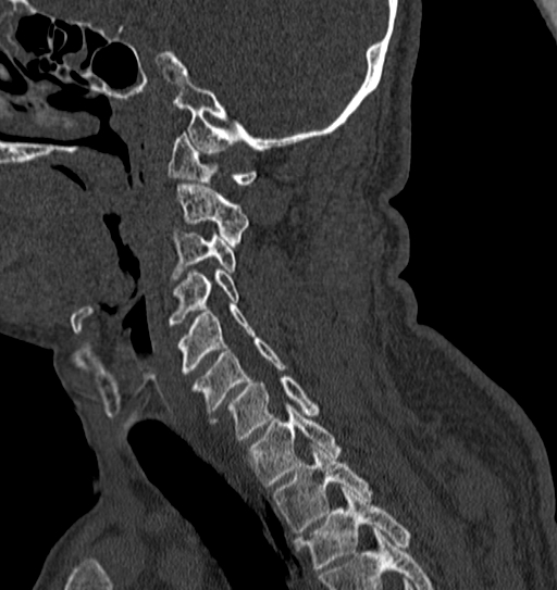 Cervical spine trauma with tear drop fracture and perched facet joint (Radiopaedia 53989-60127 Sagittal bone window 54).jpg