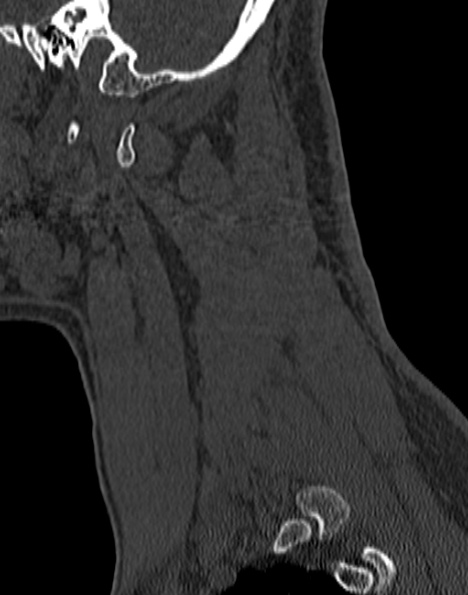 File:Cervical spondylodiscitis (Radiopaedia 28057-29489 Sagittal bone window 14).jpg