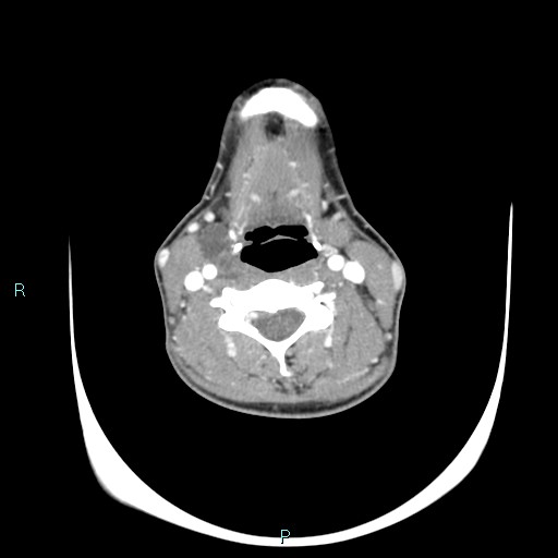 Cervical thymic cyst (Radiopaedia 88632-105335 B 62).jpg