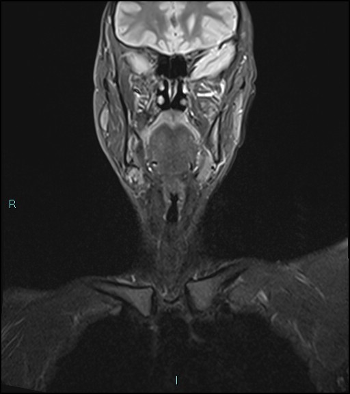 File:Cervical thymic cyst (Radiopaedia 88632-105336 Coronal STIR 17).jpg