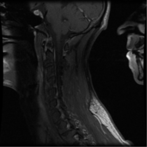 File:Cervical vertebrae metastasis (Radiopaedia 78814-91667 G 5).png
