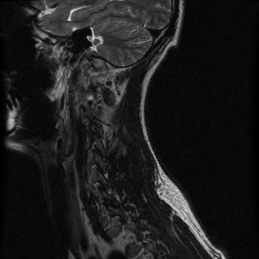 File:Cervical vertebrae metastasis (Radiopaedia 78814-91667 Sagittal T2 12).png