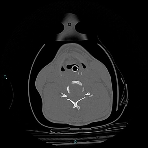 File:Cervical vertebral burst fracture (Radiopaedia 37420-39258 Axial bone window 18).jpg