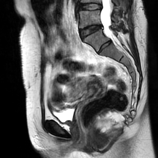 File:Cesarian section scar endometriosis (Radiopaedia 66520-75799 Sagittal T2 1).jpg