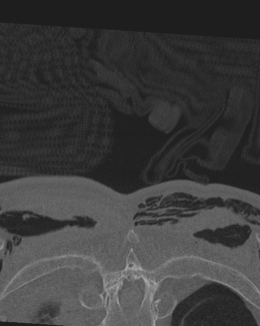 Chalk stick fracture (Radiopaedia 57948-64928 Coronal bone window 78).png