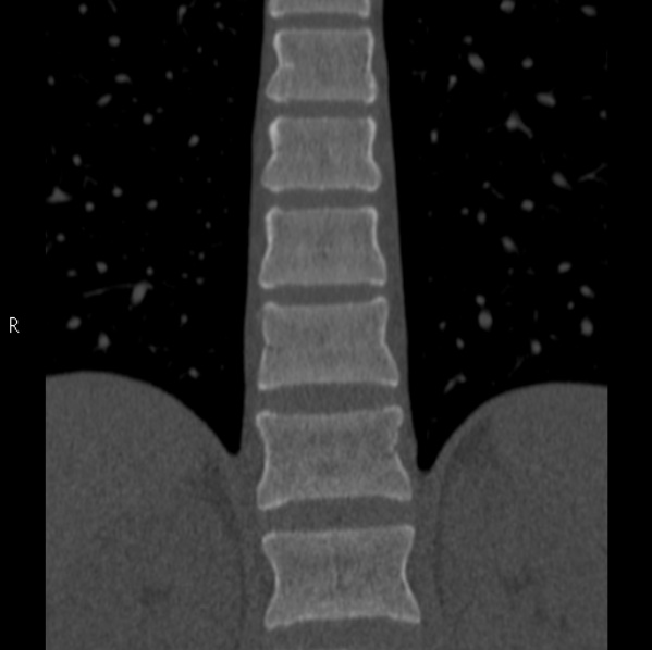 File:Chance fracture (Radiopaedia 36521-38081 Coronal bone window 25).jpg