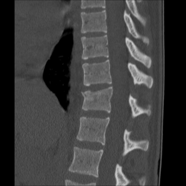 Chance fracture (Radiopaedia 36521-38081 Sagittal bone window 30).jpg