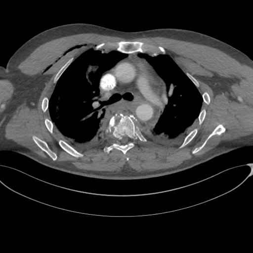 File:Chest multitrauma - aortic injury (Radiopaedia 34708-36147 A 115).png