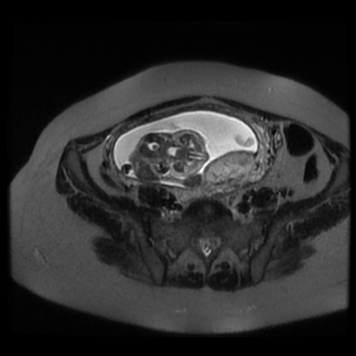 Chiari II malformation - fetal MRI (Radiopaedia 68099-77581 Axial T2-SSFSE 35).jpg
