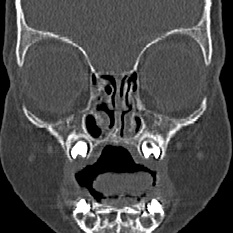 Choanal atresia (Radiopaedia 88525-105975 Coronal bone window 22).jpg