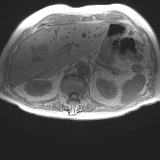 File:Cholangiocarcinoma - mass-forming pattern (Radiopaedia 16017-15677 T1 in-phase 11).jpg