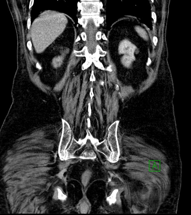 Cholangiocarcinoma with cerebral metastases (Radiopaedia 83519-98629 G 66).jpg