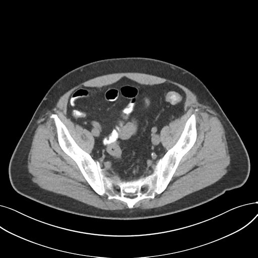 Cholecystitis with focal perforation and hepatic abscess (Radiopaedia 37189-38945 Axial non-contrast 70).png