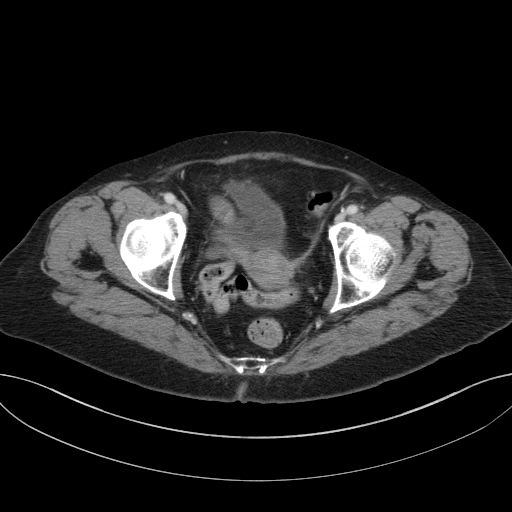 Cholecystoduodenal fistula due to calculous cholecystitis with gallstone migration (Radiopaedia 86875-103077 D 73).jpg