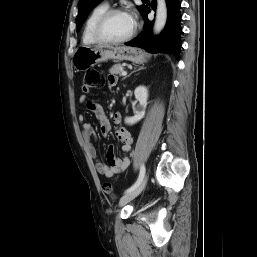 Choledocholiathiasis with normal caliber common bile duct (Radiopaedia 75368-86632 D 104).jpg
