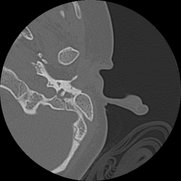 Cholesteatoma (Radiopaedia 73023-83750 Axial Left ear 1).jpg