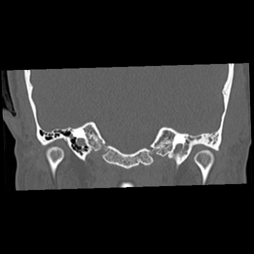 Cholesteatoma (Radiopaedia 84960-100474 Coronal bone window 27).jpg