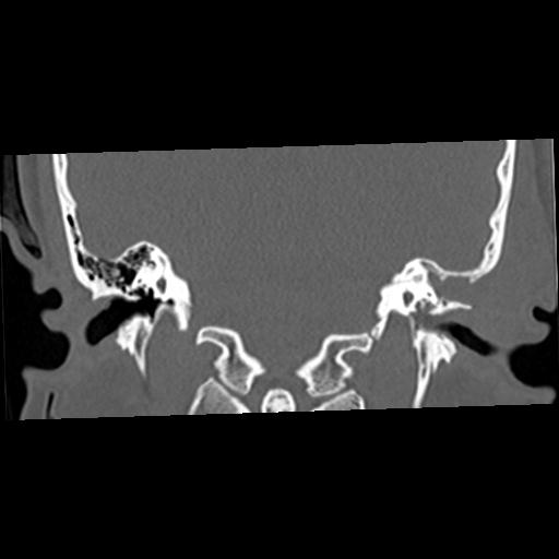 Cholesteatoma (Radiopaedia 84960-100474 Coronal bone window 37).jpg