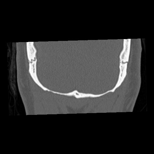 Cholesteatoma (Radiopaedia 84960-100474 Coronal bone window 78).jpg