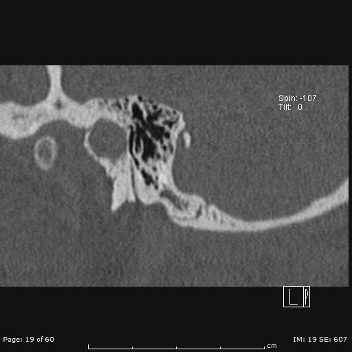 Cholesteatoma - external auditory canal (Radiopaedia 88452-105096 Sagittal bone window 19).jpg